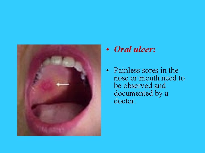  • Oral ulcer: • Painless sores in the nose or mouth need to
