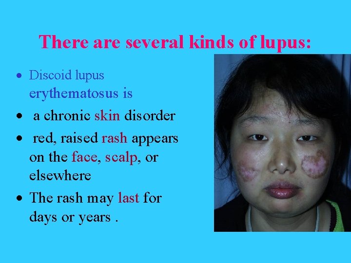There are several kinds of lupus: Discoid lupus erythematosus is a chronic skin disorder