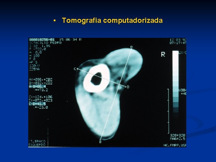  • Tomografia computadorizada 