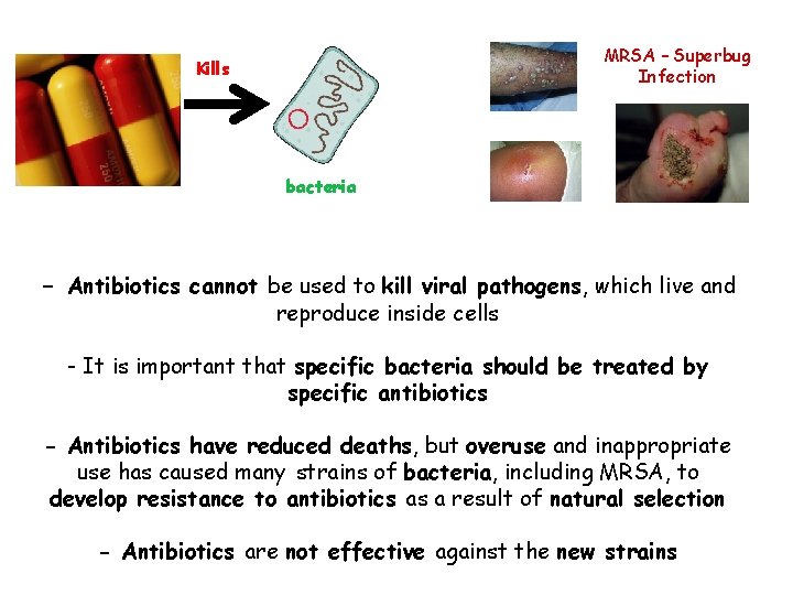 MRSA – Superbug Infection Kills bacteria - Antibiotics cannot be used to kill viral