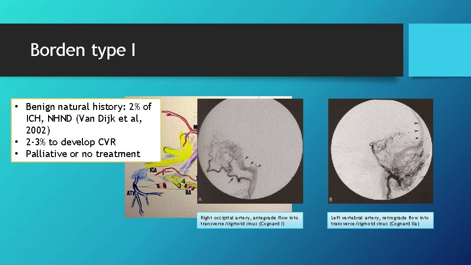 Borden type I • Benign natural history: 2% of ICH, NHND (Van Dijk et