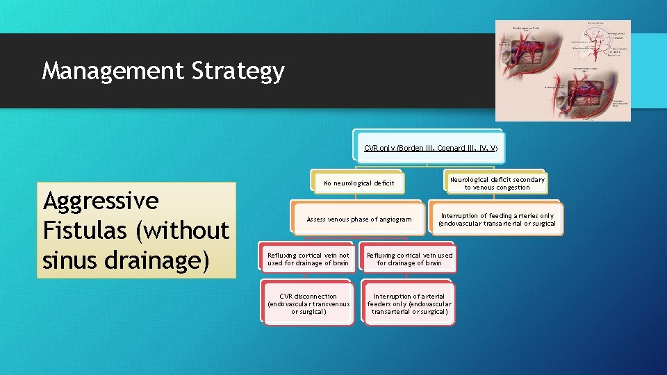Management Strategy CVR only (Borden III, Cognard III, IV, V) Aggressive Fistulas (without sinus