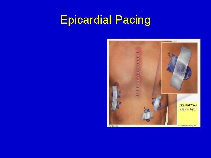 Epicardial Pacing 