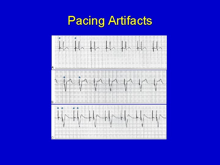 Pacing Artifacts 