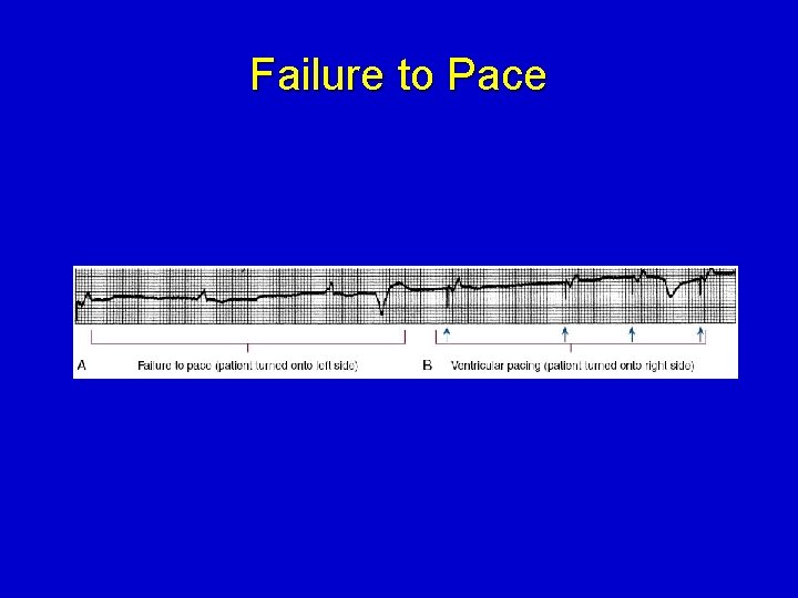 Failure to Pace 