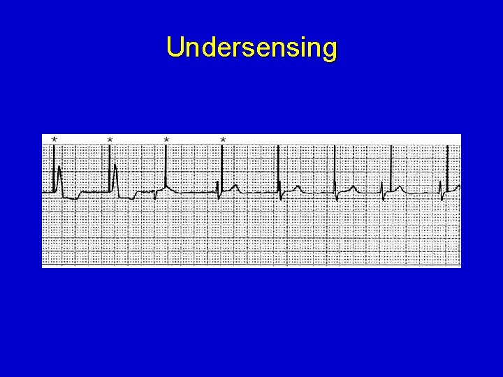 Undersensing 