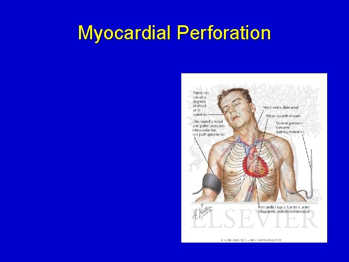 Myocardial Perforation 