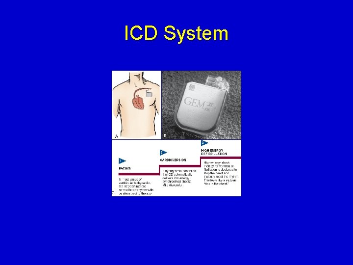 ICD System 