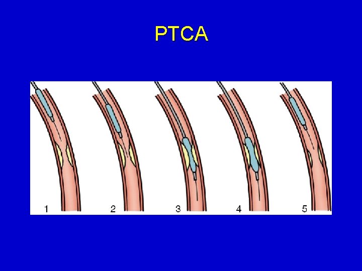 PTCA 