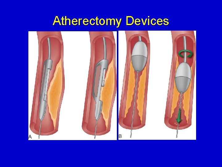 Atherectomy Devices 