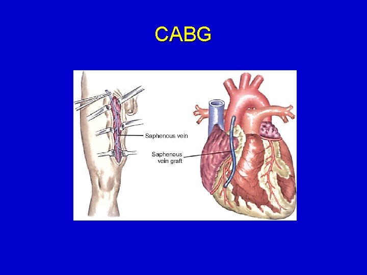 CABG 