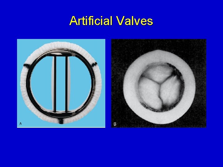 Artificial Valves 