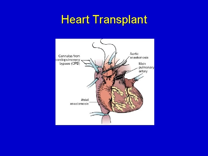 Heart Transplant 