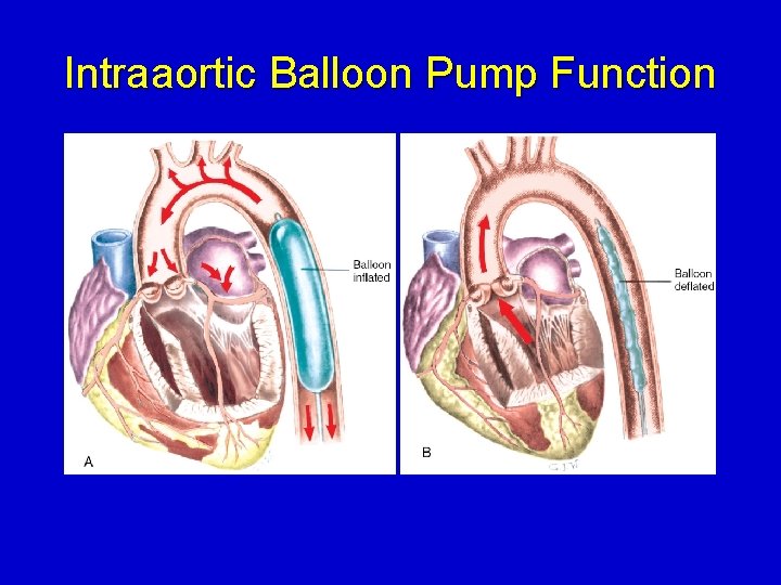 Intraaortic Balloon Pump Function 