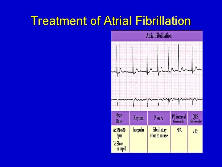 Treatment of Atrial Fibrillation 