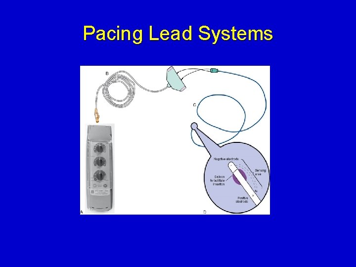 Pacing Lead Systems 