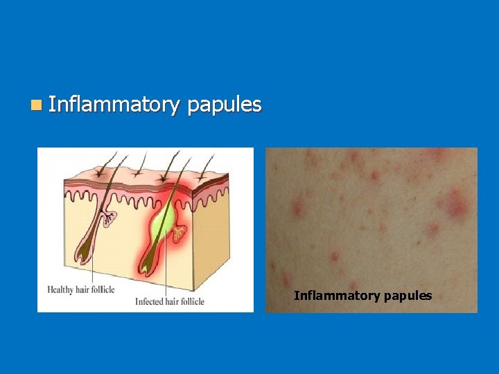 n Inflammatory papules 