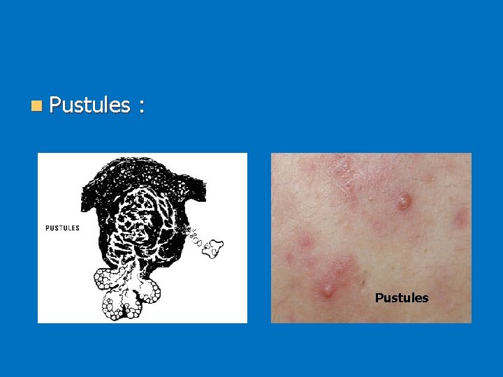 n Pustules : Pustules 