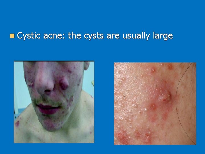 n Cystic acne: the cysts are usually large 