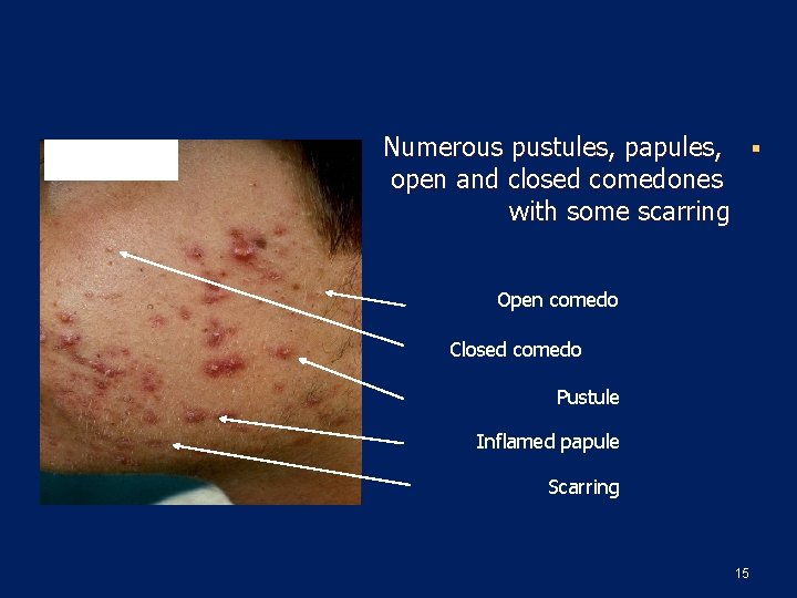 Numerous pustules, papules, § open and closed comedones with some scarring Open comedo Closed