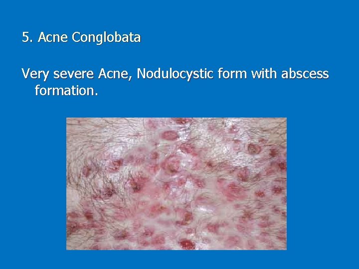 5. Acne Conglobata Very severe Acne, Nodulocystic form with abscess formation. 