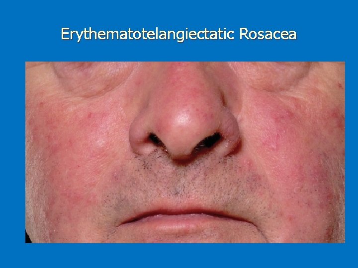 Erythematotelangiectatic Rosacea 