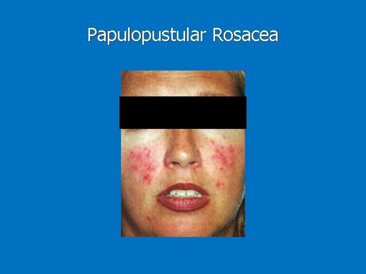 Papulopustular Rosacea 