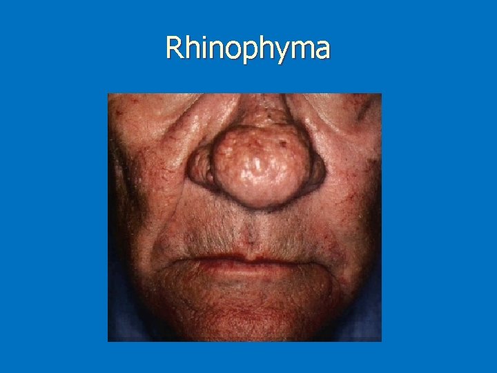 Rhinophyma 