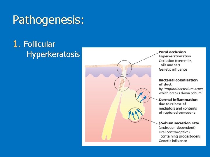 Pathogenesis: 1. Follicular Hyperkeratosis 