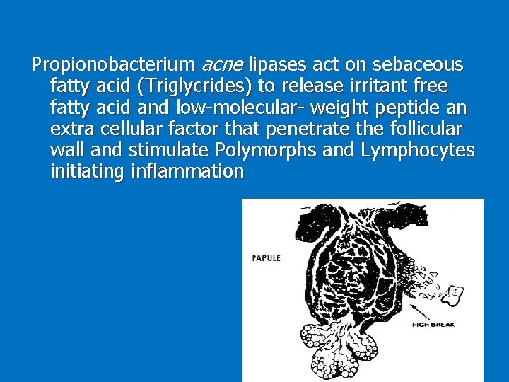 Propionobacterium acne lipases act on sebaceous fatty acid (Triglycrides) to release irritant free fatty