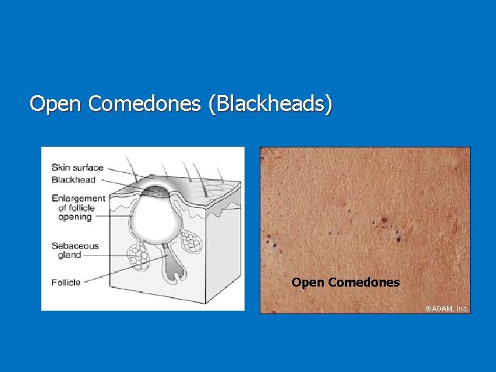Open Comedones (Blackheads) Open Comedones 