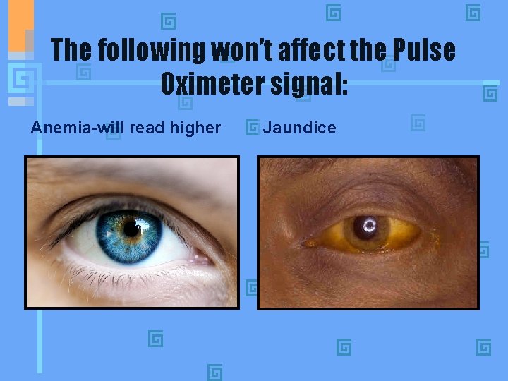 The following won’t affect the Pulse Oximeter signal: Anemia-will read higher Jaundice 