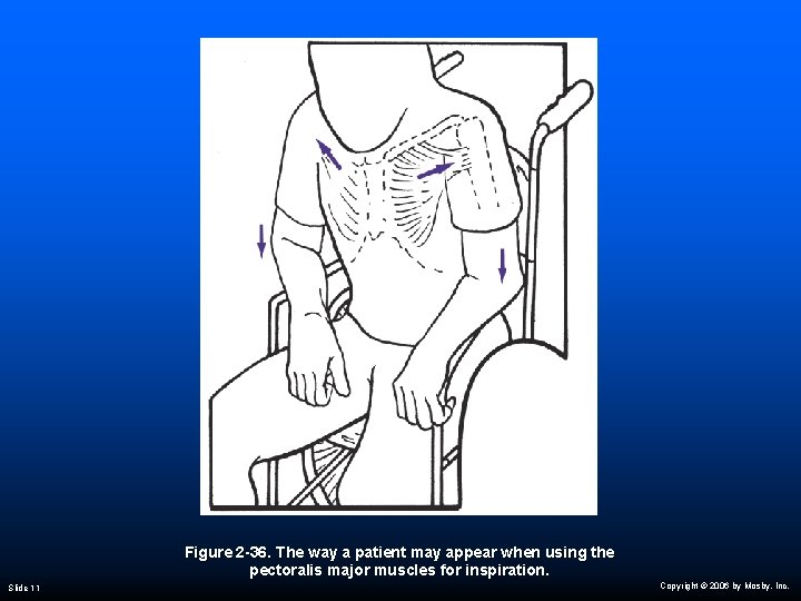 Figure 2 -36. The way a patient may appear when using the pectoralis major