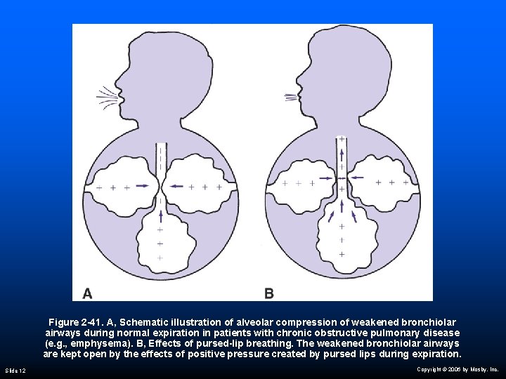 Figure 2 -41. A, Schematic illustration of alveolar compression of weakened bronchiolar airways during