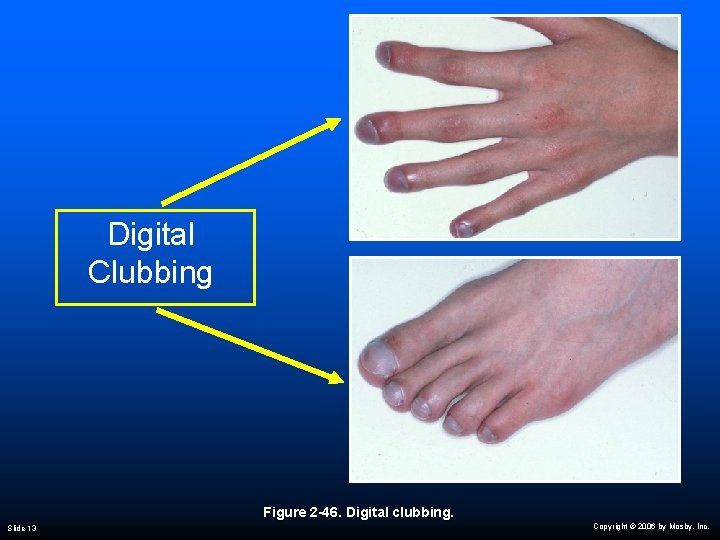 Digital Clubbing Figure 2 -46. Digital clubbing. Slide 13 Copyright © 2006 by Mosby,