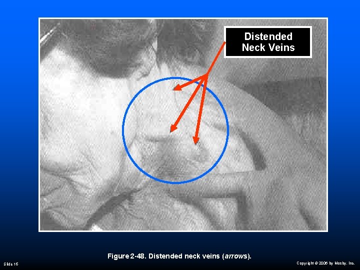 Distended Neck Veins Figure 2 -48. Distended neck veins (arrows). Slide 15 Copyright ©