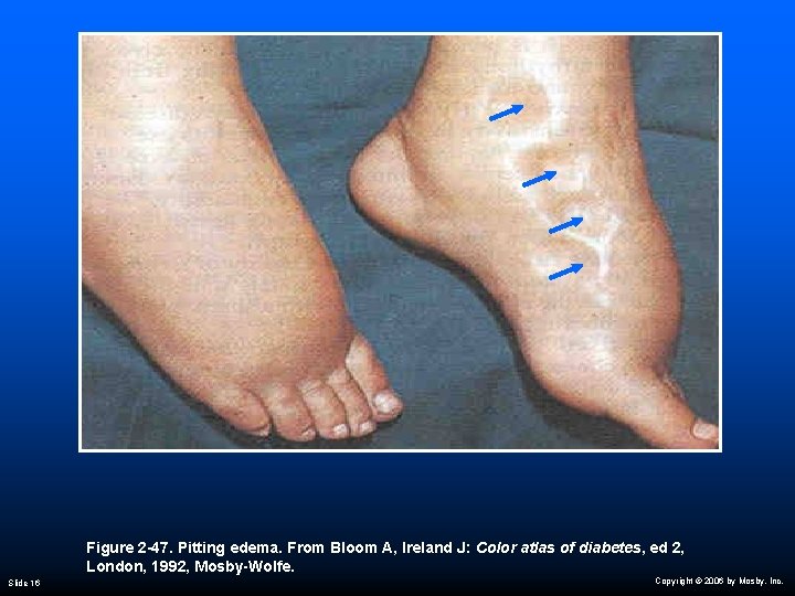 Figure 2 -47. Pitting edema. From Bloom A, Ireland J: Color atlas of diabetes,