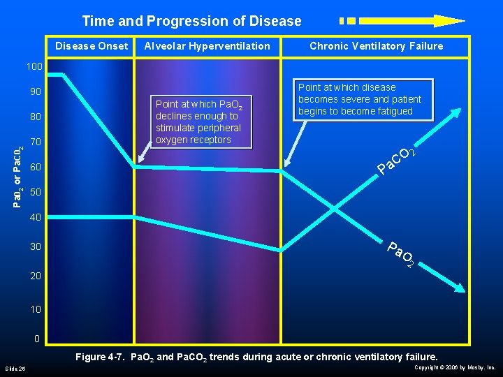 Time and Progression of Disease Onset Alveolar Hyperventilation Chronic Ventilatory Failure 100 90 Pa