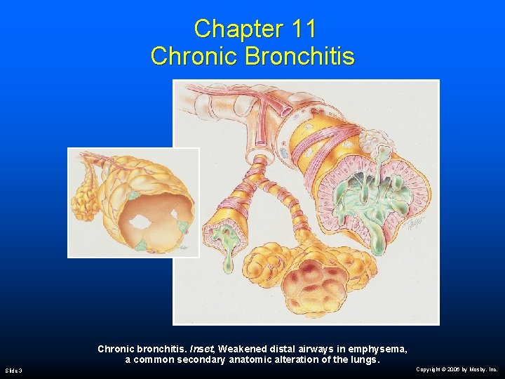 Chapter 11 Chronic Bronchitis Chronic bronchitis. Inset, Weakened distal airways in emphysema, a common