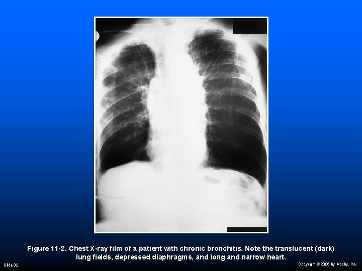 Figure 11 -2. Chest X-ray film of a patient with chronic bronchitis. Note the