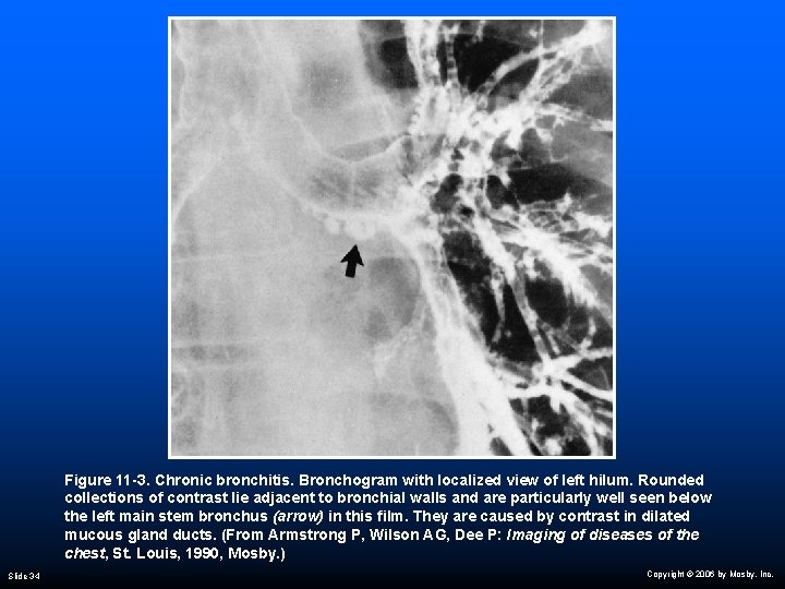 Figure 11 -3. Chronic bronchitis. Bronchogram with localized view of left hilum. Rounded collections