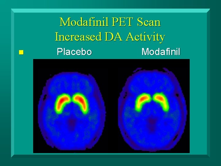 Modafinil PET Scan Increased DA Activity n Placebo Modafinil 