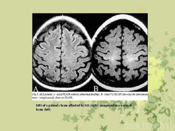 MRI of a patients brain affected by ALS (right) compared to a normail brain