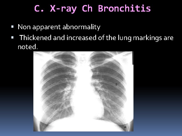 C. X-ray Ch Bronchitis Non apparent abnormality Thickened and increased of the lung markings