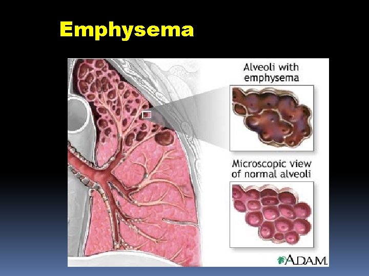 Emphysema 