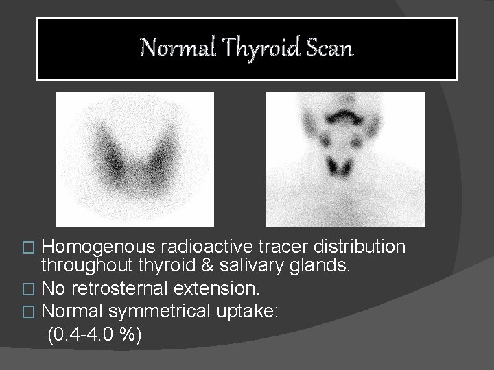 Normal Thyroid Scan Homogenous radioactive tracer distribution throughout thyroid & salivary glands. � No