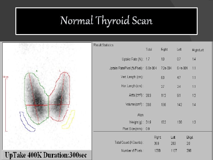 Normal Thyroid Scan 