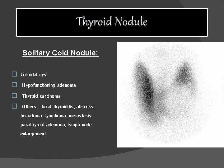 Thyroid Nodule Solitary Cold Nodule: � Colloidal cyst � Hypofunctioning adenoma � Thyroid carcinoma