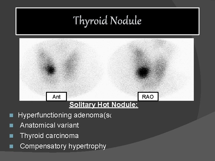 Thyroid Nodule Ant n n Solitary Hot Nodule: Hyperfunctioning adenoma(s( Anatomical variant Thyroid carcinoma