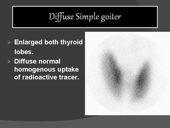 Diffuse Simple goiter Enlarged both thyroid lobes. Ø Diffuse normal homogenous uptake of radioactive